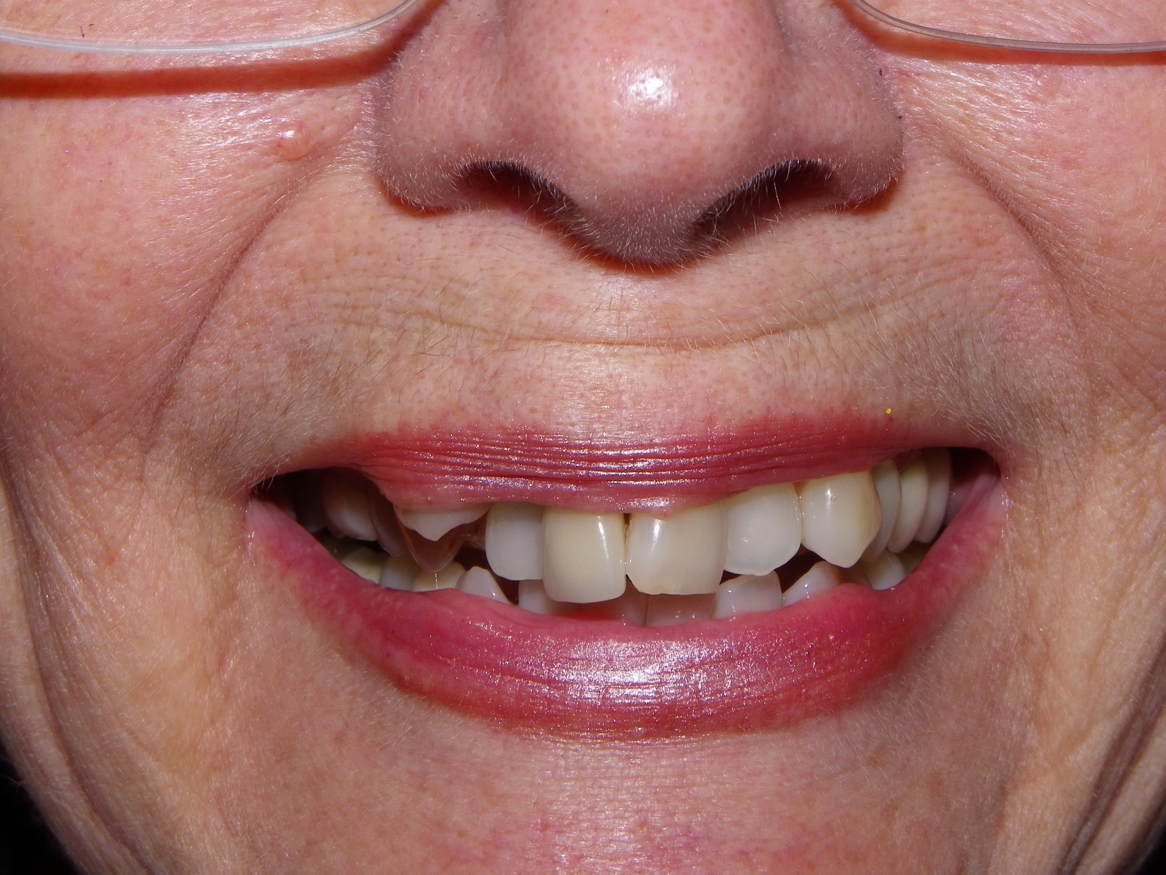 A Bridge Can Replace Missing Teeth Dr Dove Dental